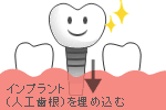 implant.gif